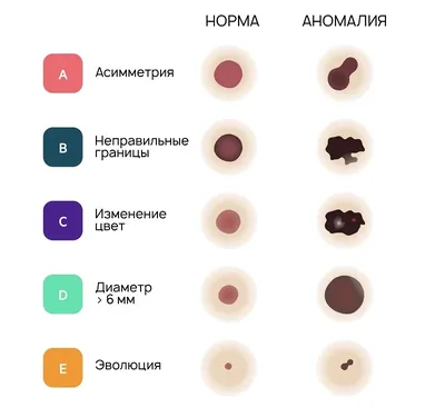 Плоскоклеточный рак кожи: клинические рекомендации