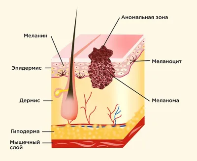 Рак кожи (меланома): факторы риска, дерматоскопия