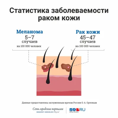 Как выглядит рак кожи и как распознать меланому или базалиому, фото  злокачественных новообразований на коже - 2 августа 2022 - 74.ru