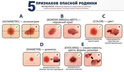 Ранняя диагностика меланомы: к кому обратиться при подозрениях