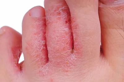 Лечение микоза и грибковых заболеваний кожи | ESTET-PORTAL | Дзен