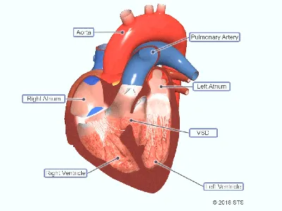 Doctor BOSTI - 💔Порок сердца - это смертельно опасное заболевание, причем  развивается оно в период внутриутробного созревания🤰🏻. То есть человек  рождается с маленьким дефектом в виде отверстия сердечной ткани. Такое  явление рано