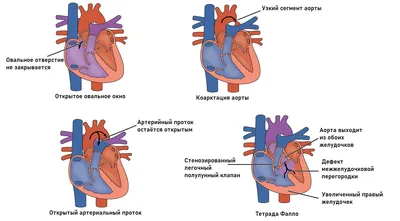 Лечение врожденного порока сердца