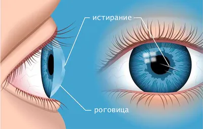 Истирание роговицы (царапина): первая помощь | unimedhealth | Дзен