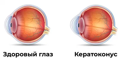 Так выглядит глаз после кератопротезирования (хирургическая процедура, при  которой больная роговица заменяется искусственной роговицей) : r/Pikabu