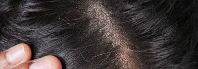 себорея кожи головы лечение кожных заболеваний Стоковое Фото - изображение  насчитывающей портрет, красно: 224006454
