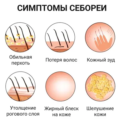 Себорейный дерматит на коже и голове - причины, симптомы, диагностика,  лечение