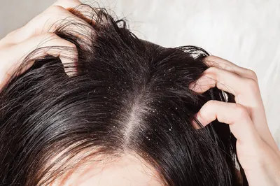 Себорея волосистой части головы: причины, диагностика, лечение. - Мир  здоровья - сеть клиник в Санкт-Петербурге