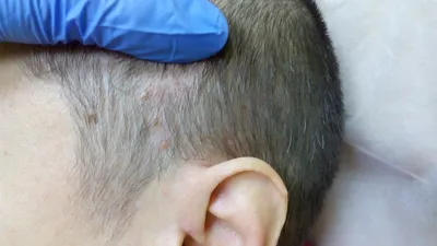 Себорейный дерматит и выпадение волос: какая связь, как лечить и  предупредить📌 - статьи экспертов Селенцин