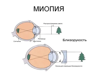 Отслоение сетчатки глаза: что это такое и чем опасно? «Ochkov.net»