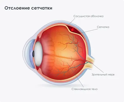 Причины отслоения сетчатки глаза | Иль | Дзен