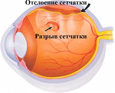 Разрывы сетчатки глаза: симптомы, причины, лечение, последствия «Ochkov.net»