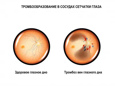 Создана искусственная сетчатка глаза из мягких биоматериалов