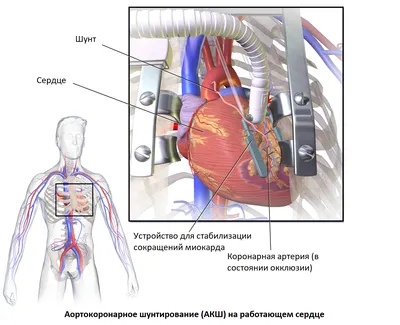 Коронарное шунтирование через малый доступ бесплатно по полису ОМС