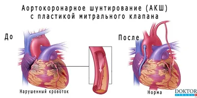 АКШ на работающем сердце — Википедия