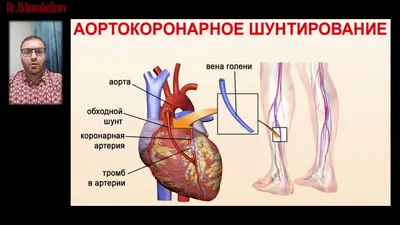 Операция шунтирование сердца – цена в ФНКЦ ФМБА России