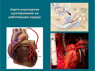 Инвалидность при шунтировании сердца в 2023 году: условия и порядок  получения