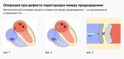 Лечение аортокоронарное шунтирование в Израиле в клинике Хадасса