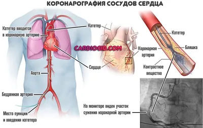 Кардиохирург Колесов провел первое коронарное шунтирование работающего  сердца - Знаменательное событие