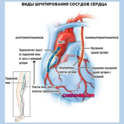 Коронарное шунтирование на \"работающем сердце\"