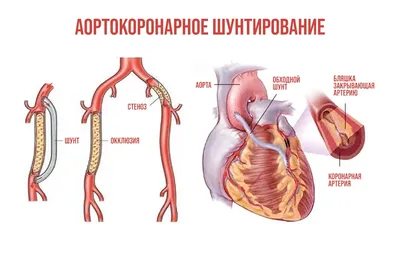 Впервые в Алматинской области проведена операция на аортокоронарное шунтирование  сердца