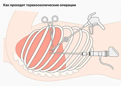 14 вопросов кардиохирургу о современной хирургии сердца