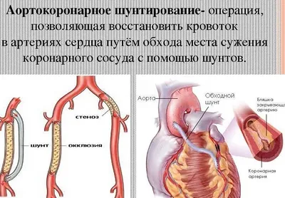 Шунтирование сердца: что нужно знать?