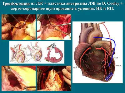 Аортокоронарное шунтирование — \"Ацинус\" и Больница Святого Луки