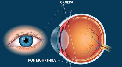 Склерит и склерокератит. Причины заболевания, симптомы, лечение -  энциклопедия Ochkov.net