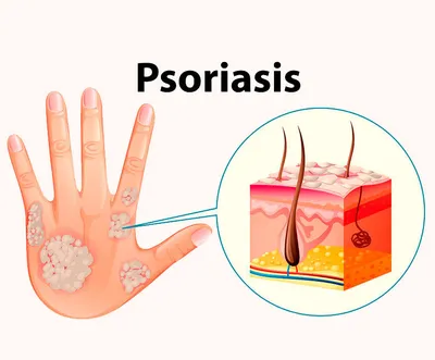 Псориаз — показания, симптомы и побочные эффекты