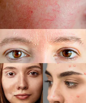 Проблемы кожи лица (купероз, черные точки, морщины): причины возникновения,  профилактика, устранение