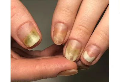 YanaD_NailArt - Изменение толщины ногтя Любое изменение толщины ногтя —  проблема, требующая своевременного лечения, ведь ногтевая пластина служит  естественной защитой кончиков пальцев. Утолщение или дистрофия ногтей —  косметический дефект, который ...