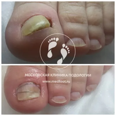 Hespera - ❗️Существует ряд симптомов благодаря которым можно распознать  #грибок #ногтей на ногах на ранней стадии: ▪️Пожелтение ногтевой пластины;  ▪️Небольшая деформация или видоизменение (если ноготь стал сильно  деформироваться); ▪️Расслоение ...