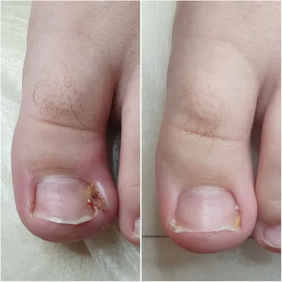 Деформация ногтевой пластины из-за неудобной обуви | Московская Клиника  Подологии