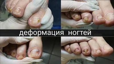 Спасаем разрушенный ноготь | Московская Клиника Подологии