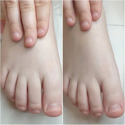 Деформация ногтевых пластин | Пожелтели ногти на ногах. Что делать