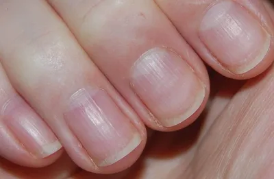 Ониходистрофия ногтей: причины деформаций, лечение.