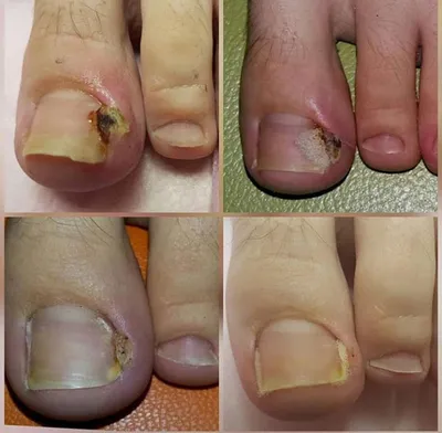 Врастание, скручивание и иные деформации роста ногтей | ООО «Медицинский  центр «Здоровые стопы»