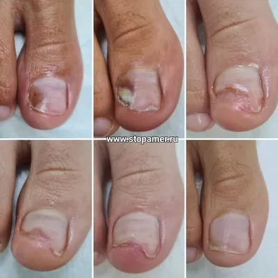 Лечение вросшего ногтя у детей в Туле - Центр подологии Доктора Дато