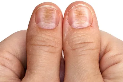 Желтеют ногти на ногах и руках: почему желтеют у женщин и мужчин, что  делать, чтобы их восстановить