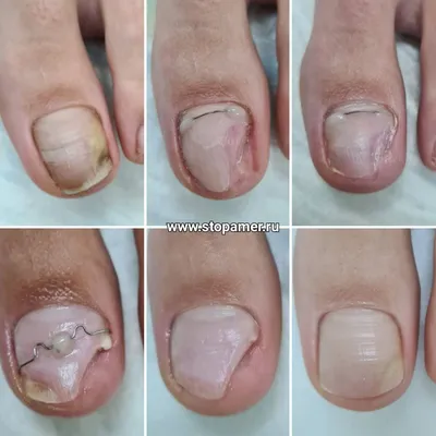 Протезирование ногтей в СПб, восстановление ногтевой пластины | клиника  «Ева»