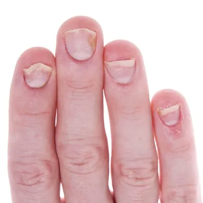 Синдром стиральной доски: что означают вмятины и бороздки на ногтях |  DOCTORPITER