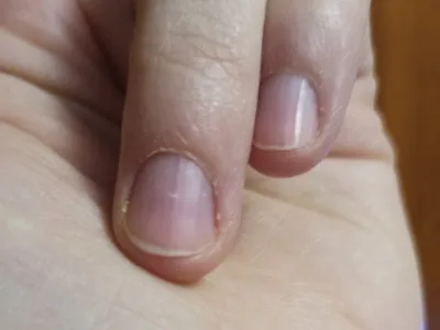 Онихолизис: причины, диагностика и лечение отслоения ногтя в Москве