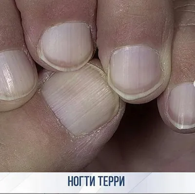 Грибок ногтей — Derma.ua