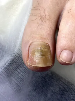 Грибок ногтей на ногах и руках: причины, первые признаки, основные симптомы.  Лечение онихомикоза в Москве