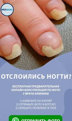 онихолизис / зачистка ногтя / травма ногтя / повреждение ногтевой пластины  / что делать - YouTube