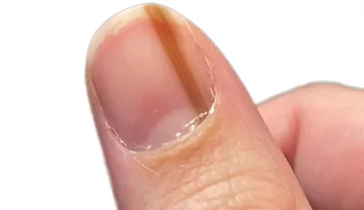 Полезно ли покрывать ногти гель-лаком? | Московская Клиника Подологии