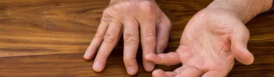 Артроз пальцев и кистей рук — симптомы, диагностика, лечение лазером |  Артрозы