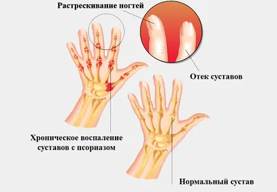 Как можно помочь диабетику с артритом. | Диабет. Здоровье. Кулинария. | Дзен