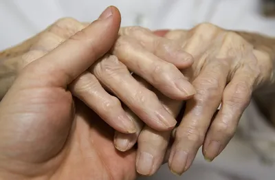 Артроз пальцев рук: методы лечения, симптомы и профилактика деформации